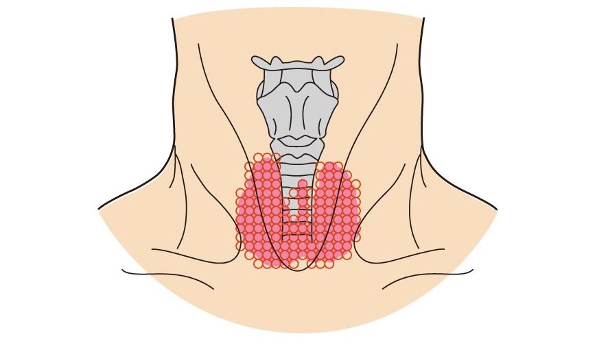 バセドウ病｜仙台市泉区で甲状腺の検査・治療は泉大沢ファミリークリニック