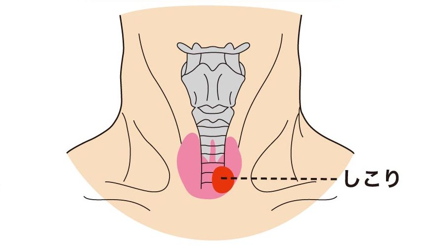 良性の腫瘍｜仙台市泉区で甲状腺の検査・治療は泉大沢ファミリークリニック