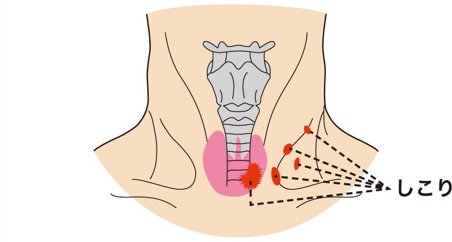 悪性の腫瘍｜仙台市泉区で甲状腺の検査・治療は泉大沢ファミリークリニック