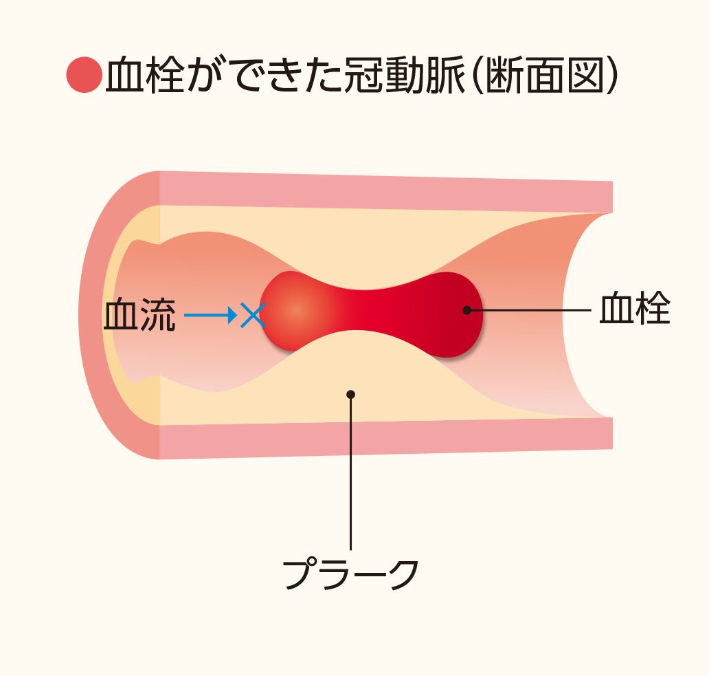 心筋 梗塞