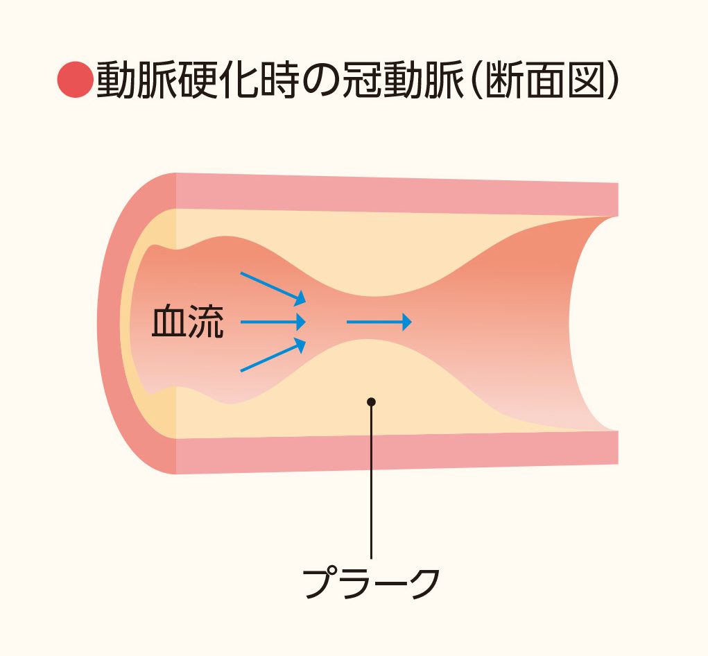 動脈硬化時の冠動脈